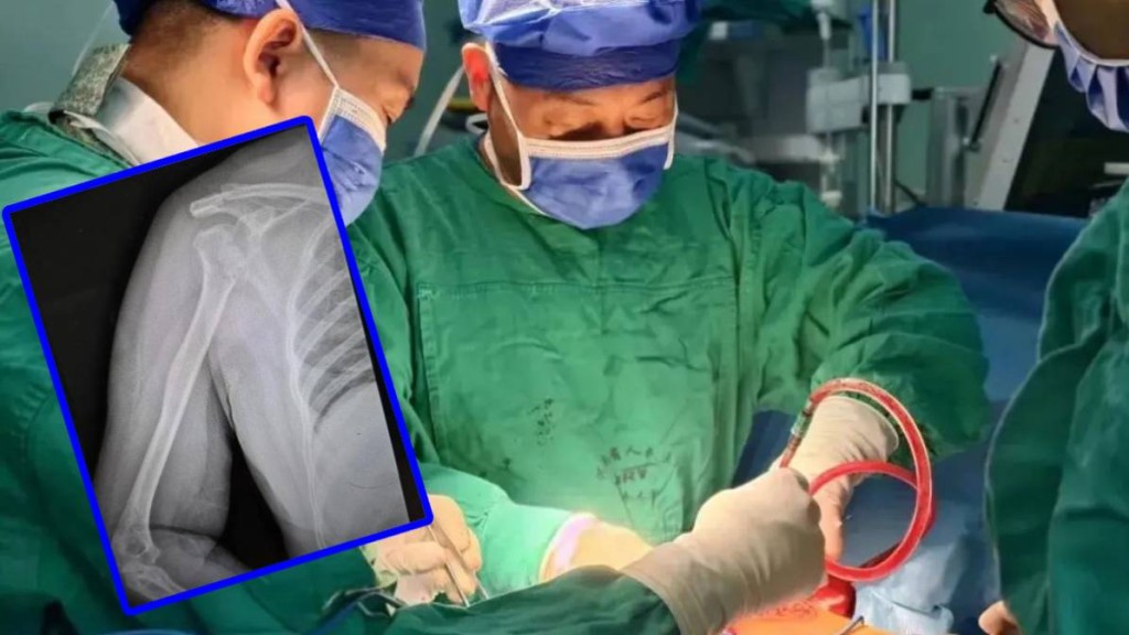 張大姐因不知患有癲癇症，睡夢中病發「震」斷自己手臂骨成七、八截。大河報