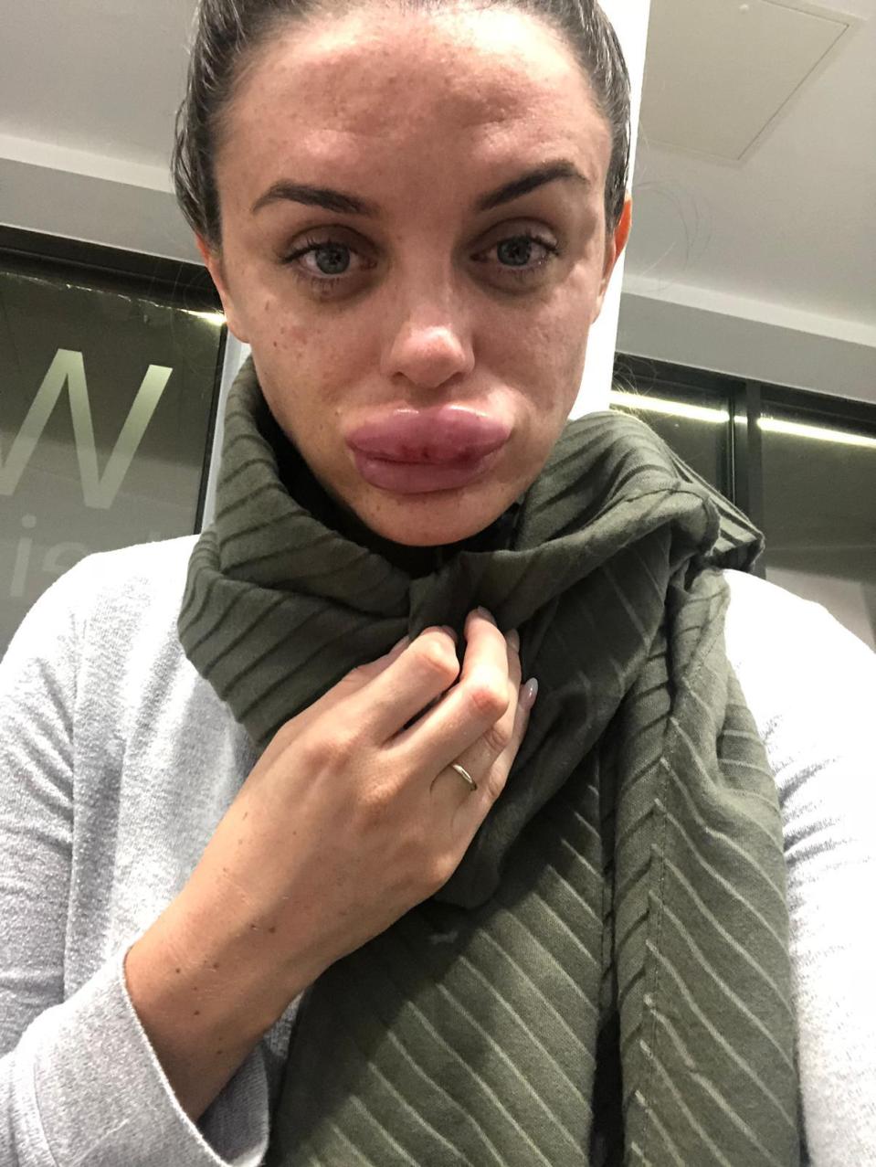 女子注射肉毒杆菌（Botox）及填充物后出现不适。网上图片