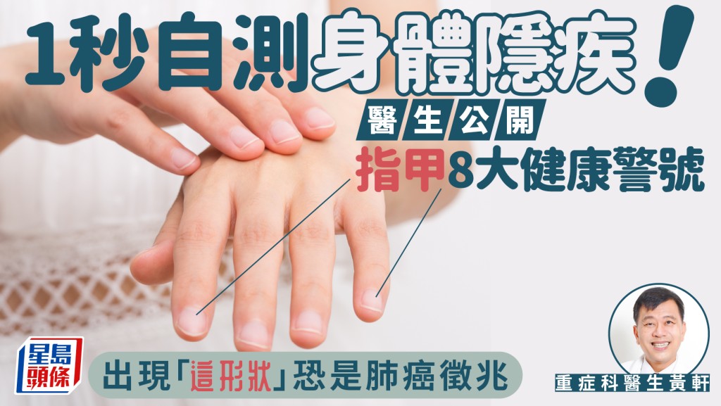 1秒自測身體隱疾！醫生公開指甲8大健康警號 出現「這形狀」恐是肺癌徵兆