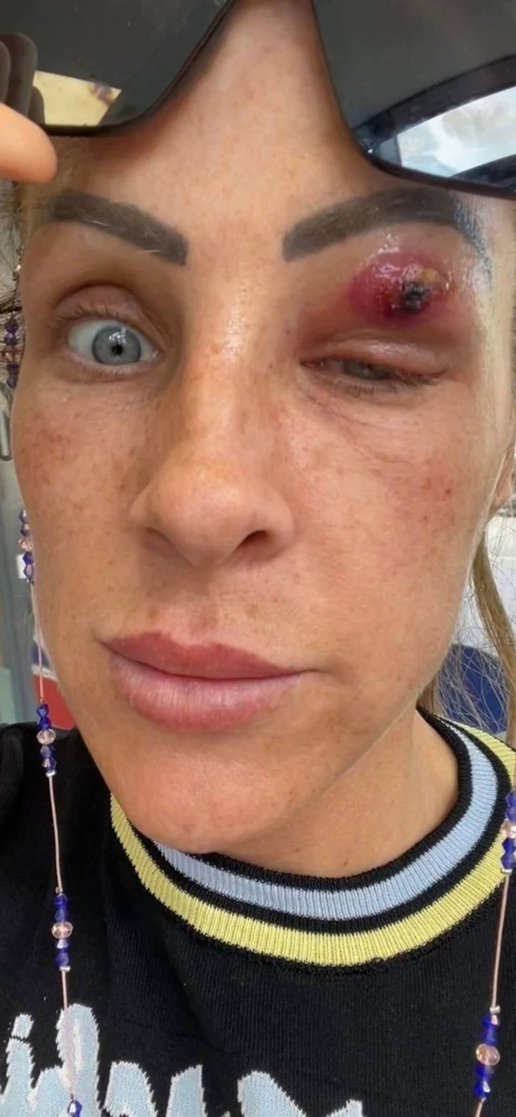 英国一名34岁妇人发现自己左眼眼皮突然红肿，1日后眼睛肿至挣不开，3日后更爆出一只满是黏液的寄生虫。（fb图片）