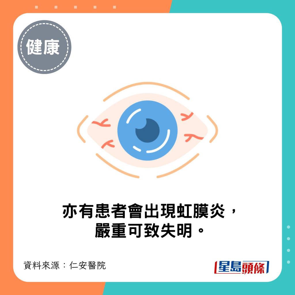 有患者会出现虹膜炎，严重可致失明。