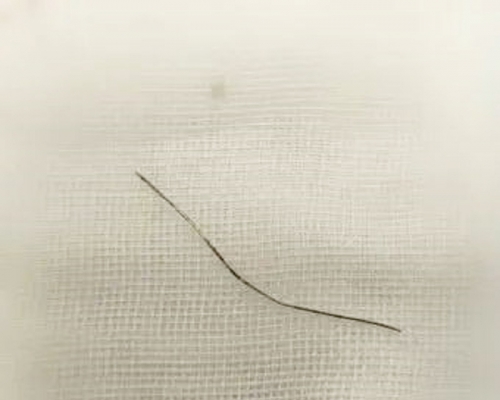 男子自行針灸治腰痛，結果10厘米長針斷體內，須手術取出。網上圖片
