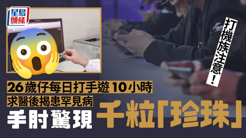 26歲男每天打手遊10小時患滑膜軟骨瘤病,手肘長出千顆「珍珠」。