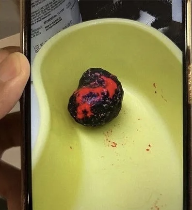 可疑粉孌一色藥粒從疑犯肛門漏出。 星暹日報微信公號 可疑粉孌一色藥粒從疑犯肛門漏出。 星暹日報微信公號