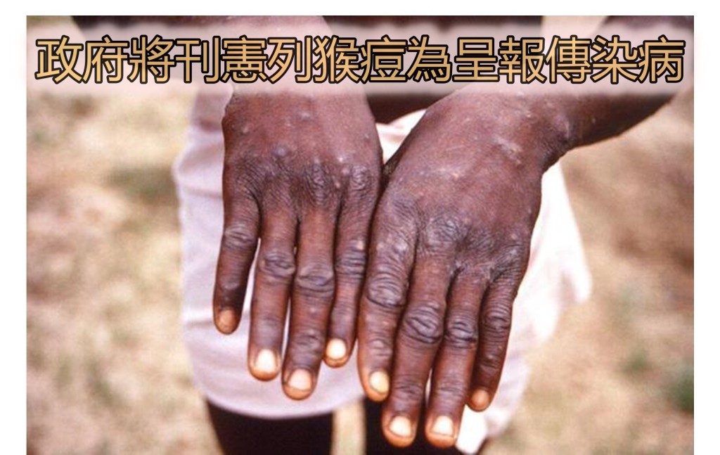 因應猴痘來勢洶洶，政府下周刊憲將猴痘列為法定呈報傳染病。資料圖片