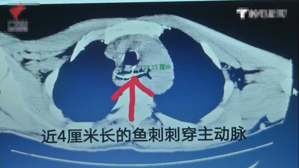 一根近4公分長的魚刺卡在陳男食道的上段。 影片截圖