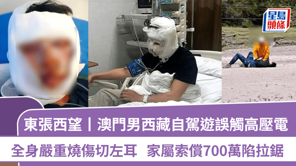 東張西望丨澳門男西藏自駕遊誤觸高壓電  全身嚴重燒傷切左耳  家屬索償700萬陷拉鋸