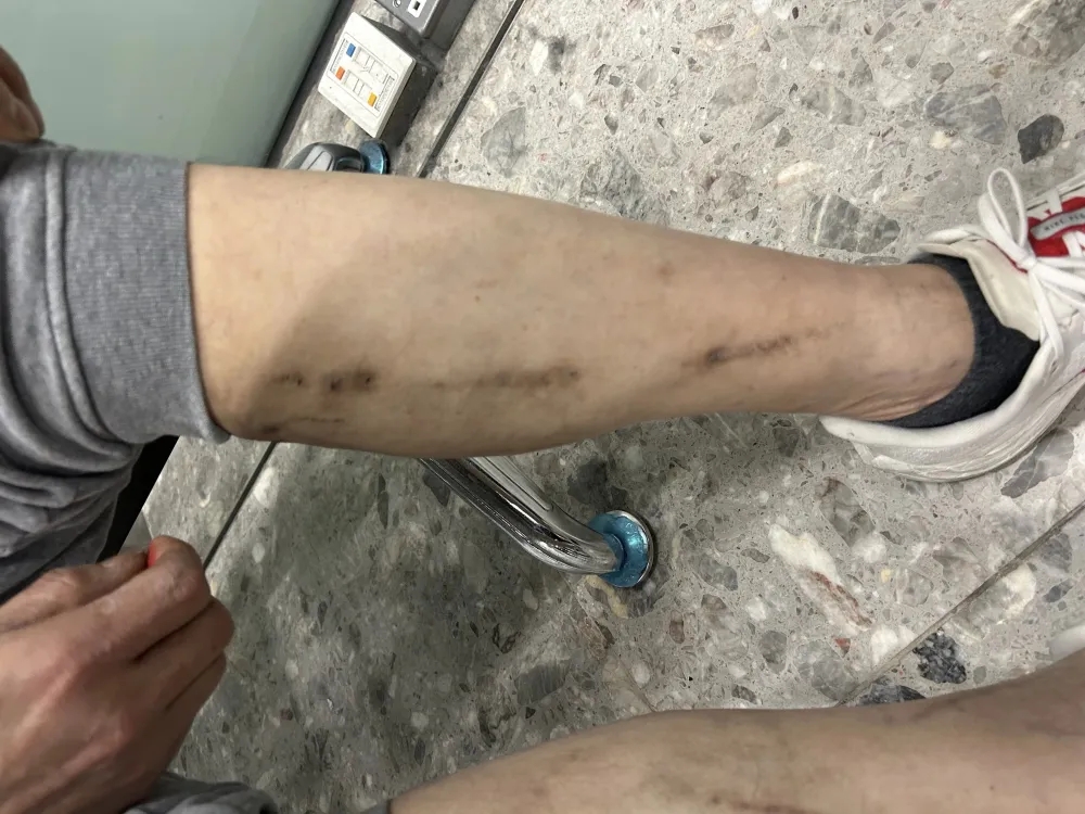 男子身上的针孔。
