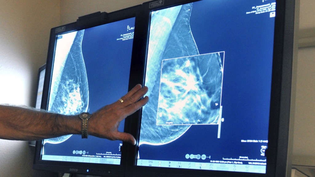 美國德州一名放射科醫生正在比較舊式2D乳房X光檢查和後來的3D 乳房X光檢查圖像。 美聯社