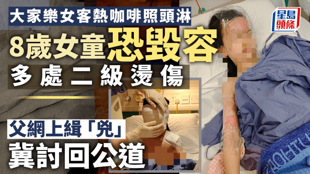 女童面部及手部多處被燙傷。將軍澳主場FB