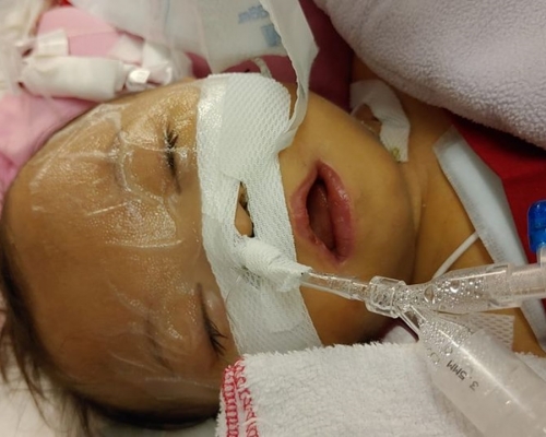 醫生指，如治療後肝功能依然未有好轉，會考慮讓悅悅離世。CoKa.Kona Baby圖片