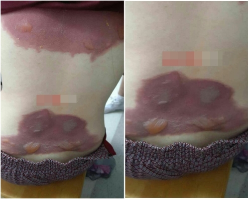浙江一名女子用新鮮蘆薈治療腰痛,結果導致腰部發紅長水泡。(網上圖片)
