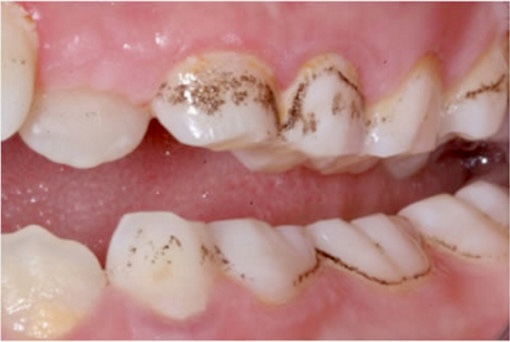  口腔中的細菌會形成牙菌斑，若感染牙齦會導致嚴重疾病。 ETtoday