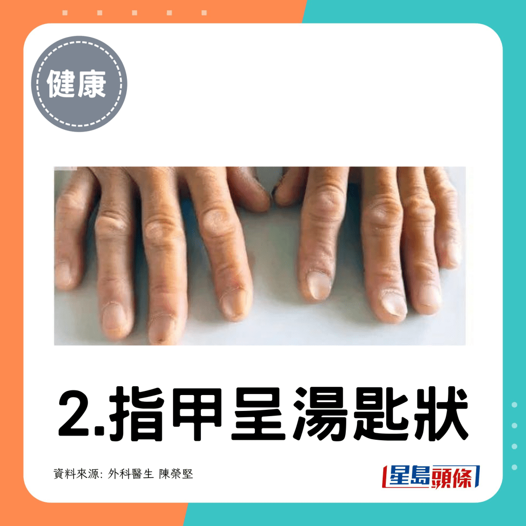 2. 指甲呈湯匙狀