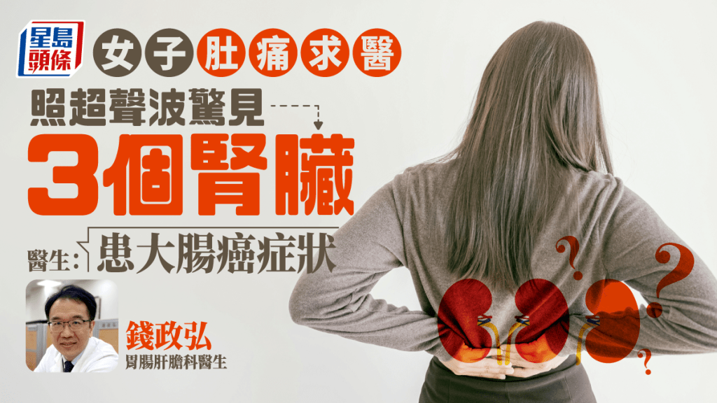 女子求醫驚見3個腎臟，醫生揭大腸癌症狀。