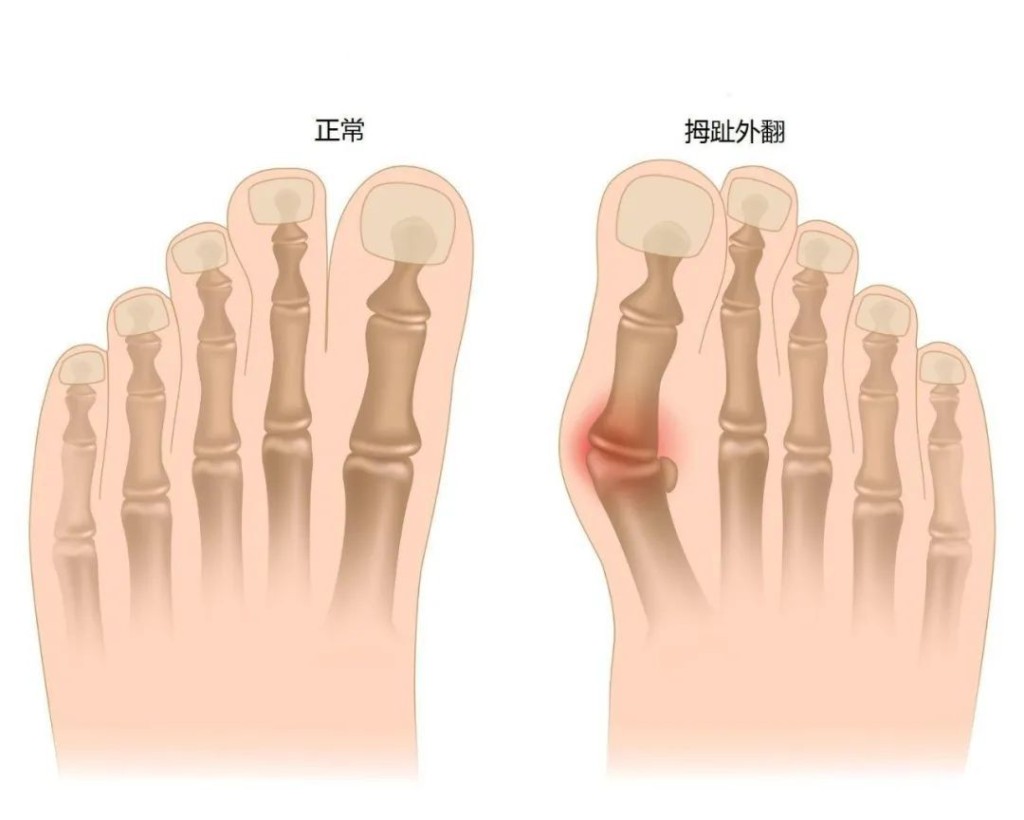 如果膝蓋中心坐落在內側腳踝甚至腳踝的內側，便可能有X形腿；而趾公姆外翻等，通常都會與X形膝同時出現。圖片由筆者提供