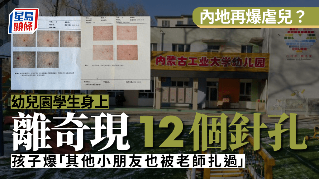 虐儿？内蒙幼儿园学生离奇现12个针孔 曾指由老师扎