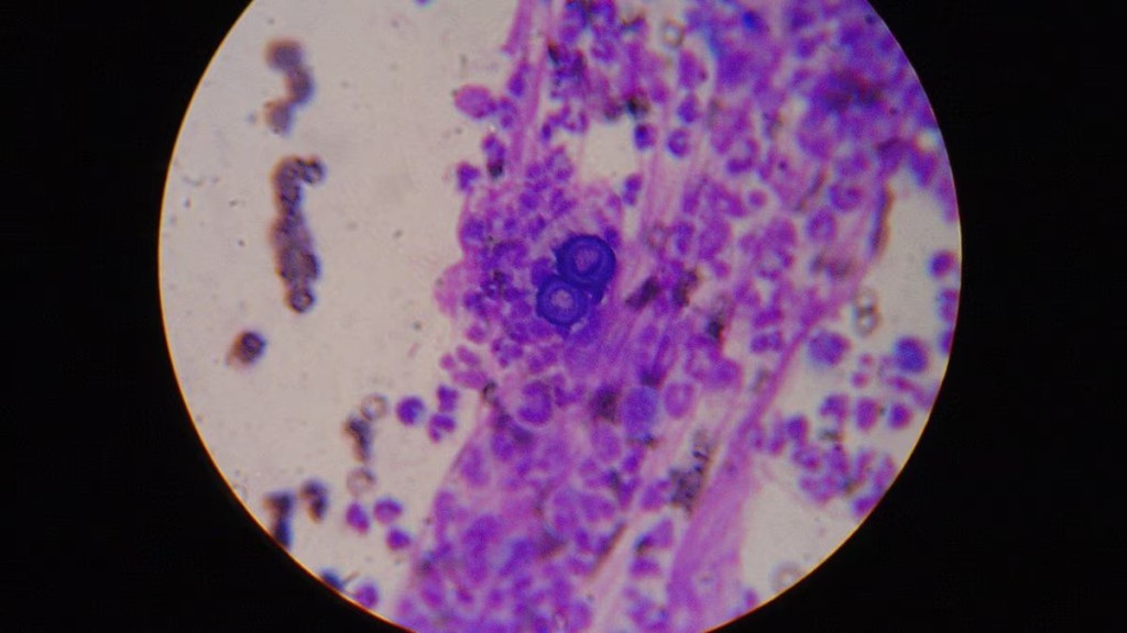 100倍显微镜下从皮肤溃疡处提取的皮炎芽生菌。 Wikimedia Commons