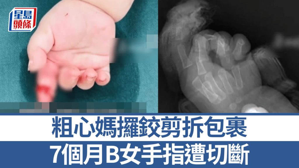 粗心妈用铰剪拆包裹，切断7个月大B女手指。《齐鲁晚报》