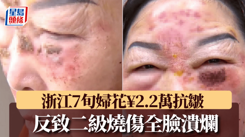 浙江7旬婦人花¥2萬美容，卻致「二度燒傷」。上游新聞
