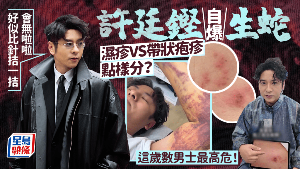 許廷鏗自爆生蛇「好似比針拮」醫生教分辨濕疹定帶狀疱疹 50歲以上男士最高危