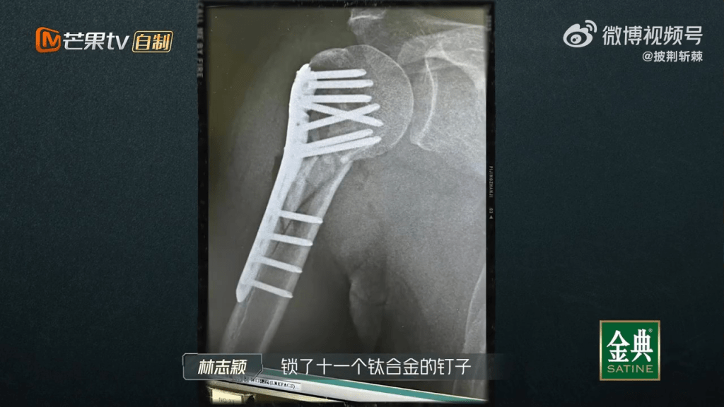 医生在林志颖手臂内钉了11支钛合金属。
