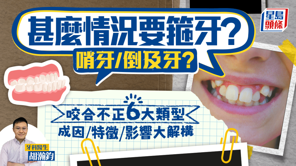 牙齒矯正｜甚麼情況要箍牙？哨牙/倒及牙？解構咬合不正6大類型 成因/特徵/影響