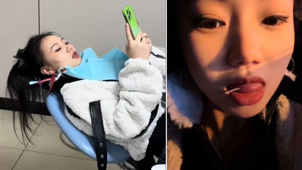 羅小姐吃黃辣丁魚時被其背鯺硬刺插入舌頭，連跑3間醫院才成功「拔骨」。抖音＠獨美