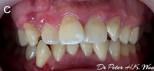 事主完成4次深层洗牙的1个月后的情况。炎症已有改善，但仍有少部分牙肉有发炎徵状，需要继续治疗，改善口腔卫生。（受访者提供）