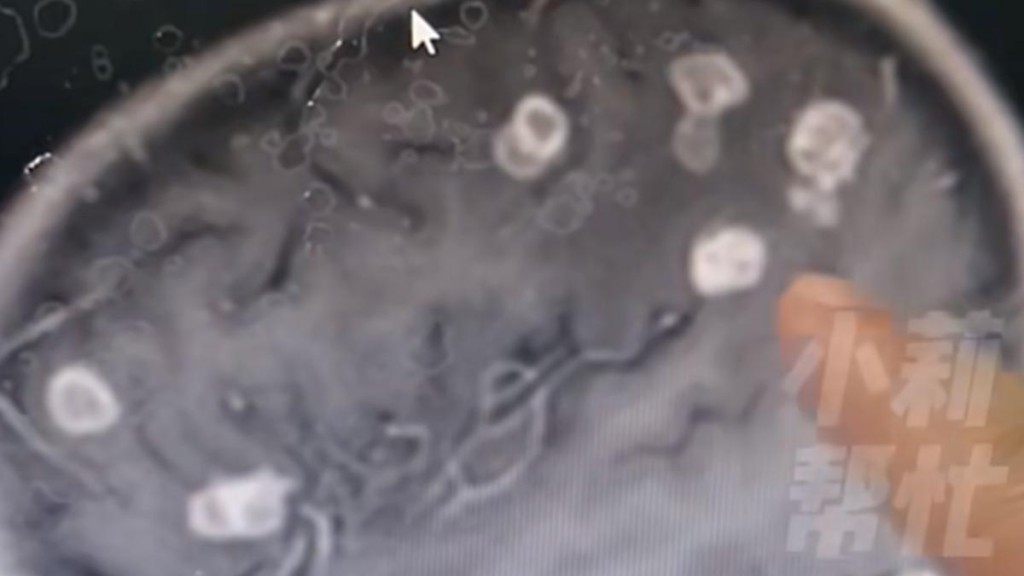 河南女童大掃除後疑吸入大量黴菌,致腦部被啃出20多個小洞。小莉幫忙 河南女童大掃除後疑吸入大量黴菌,致腦部被啃出20多個小洞。小莉幫忙