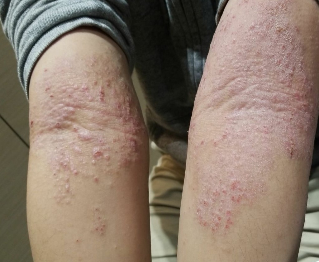寻麻疹（示意图，图片来源：allergy-free.org）