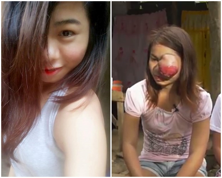 少女左眼患上视网膜母细胞瘤。网图