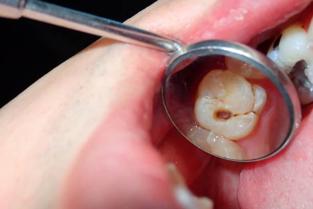 美國明尼蘇達州一名婦女在一次就診中，遭落了過量麻藥後，在幾小時內被補了20隻牙，進行了4次根管治療（杜牙根），以及鑲了8顆牙冠。