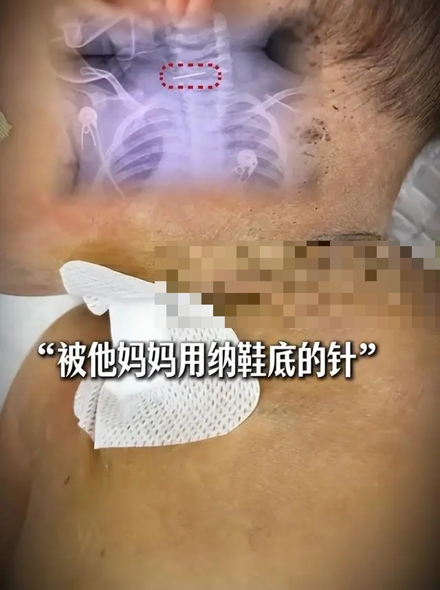 醫生稱接診10月大男嬰全身被扎數百針孔,針留在頸椎裡。 醫生稱接診10月大男嬰全身被扎數百針孔,針留在頸椎裡。