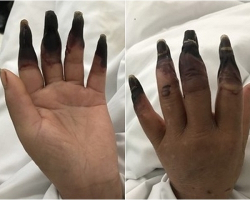 武漢一婦人患「乾燥綜合症」，早前意外弄傷無名指，導致感染，８隻指頭發黑「枯萎」。網圖
