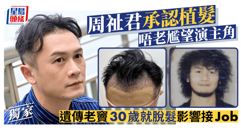 獨家丨周祉君承認植髮唔老尷望演主角 遺傳老竇30歲就脫髮影響接Job