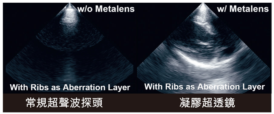 「動態控制超透鏡」可以幫助超聲波探頭緊貼皮膚，穿透肋骨，獲取清晰的心臟腔室及心臟瓣膜影像，以進行心臟疾病診斷。