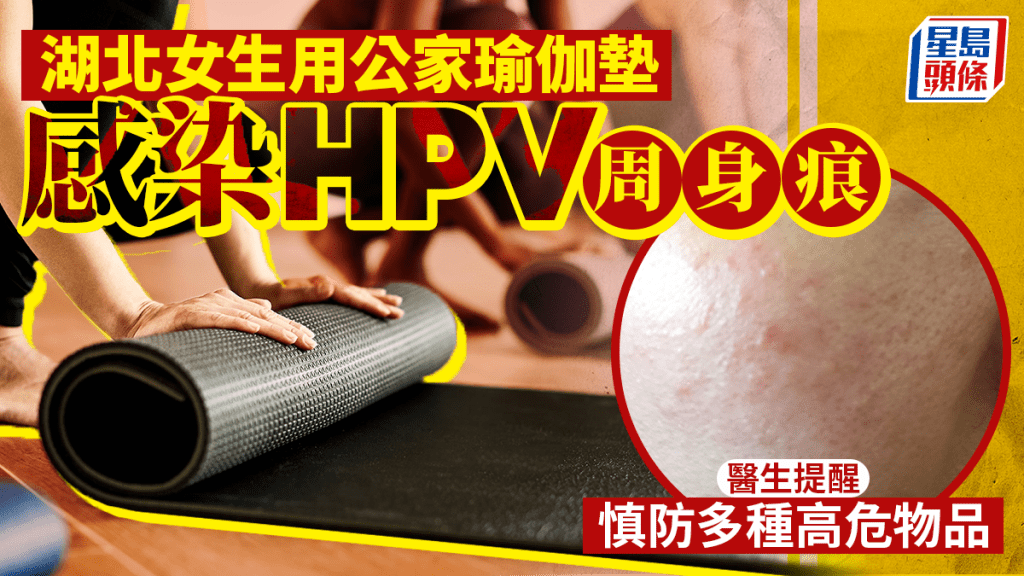 HPV｜湖北女用公家瑜伽墊周身痕確診「扁平疣」  醫生警示多種高危物品