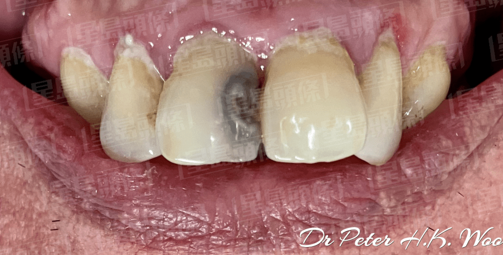 醫生指出，患者待蛀牙情況較嚴重時才求醫，幸好是次能以補牙方法挽救。（相片來源：牙科醫生胡瀚鈞）