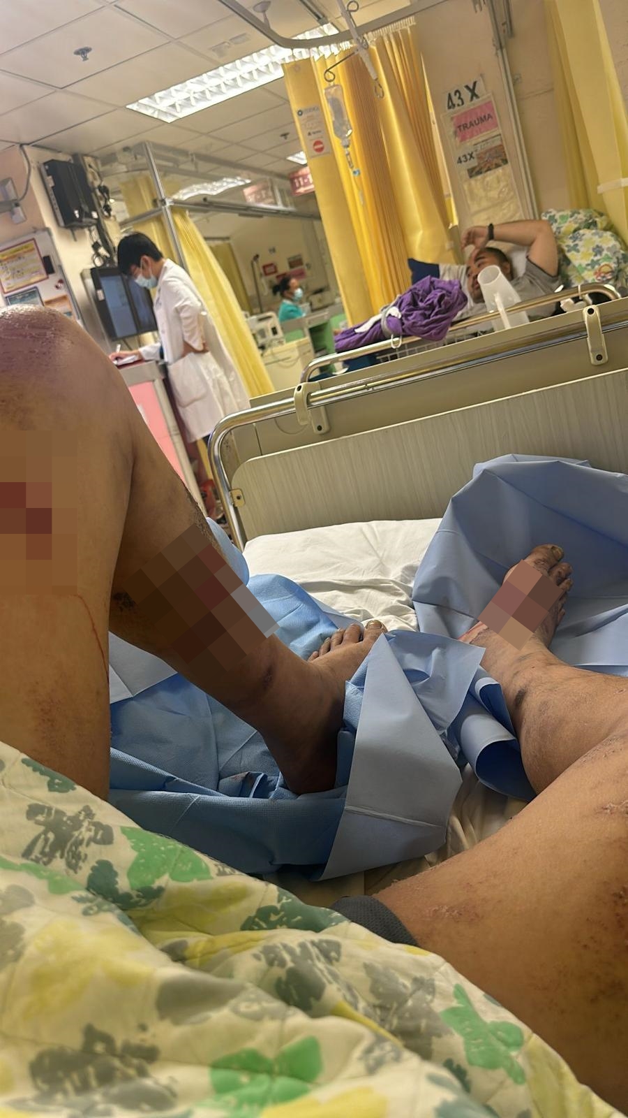 去年文禮「落石屎」期間,被灼熱混凝土灼傷腿部,但最後被迫隱瞞。受訪者提供 去年文禮「落石屎」期間,被灼熱混凝土灼傷腿部,但最後被迫隱瞞。受訪者提供