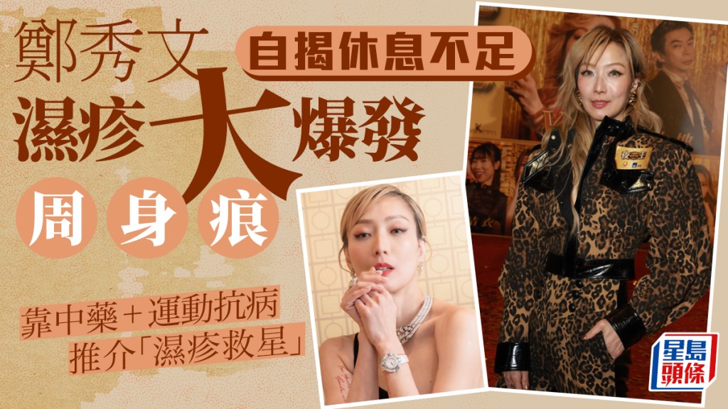 濕疹折磨多年！鄭秀文自揭濕疹爆發「周身痕」  抗病多年分享快速止痕法