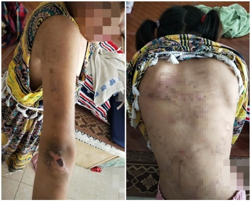 女童手臂、背部上大大小小的傷疤已經結痂。網圖