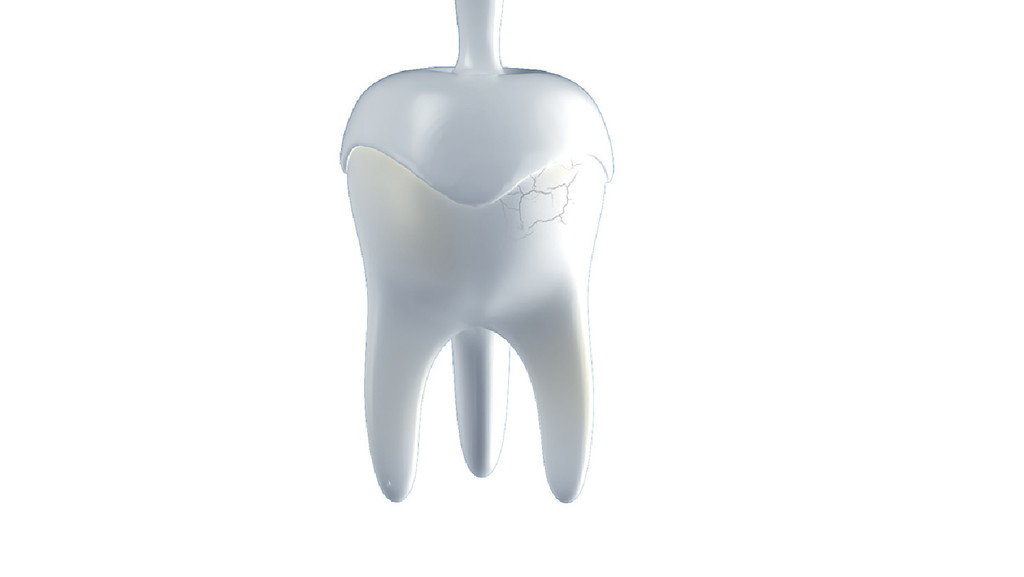 ■右邊裂痕為牙齒侵蝕情況，除了常用的氟化物，仿天然琺瑯質微粒也能保護牙齒，能在牙齒表面形成一層保護層及阻塞象牙質的微細小管（如圖中牙齒左方）。
