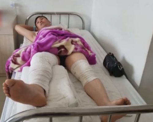 右脚韧带撕裂的王成有，由于医生在左脚上开刀，令双脚皆受伤。（网图）