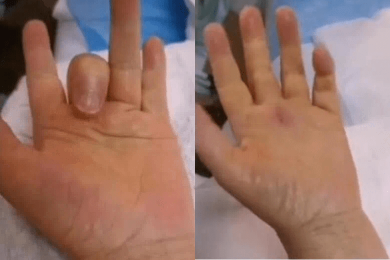 李女左手中指反覆疼痛兩個多月，且無法隨意伸直彎曲。（微博影片截圖）