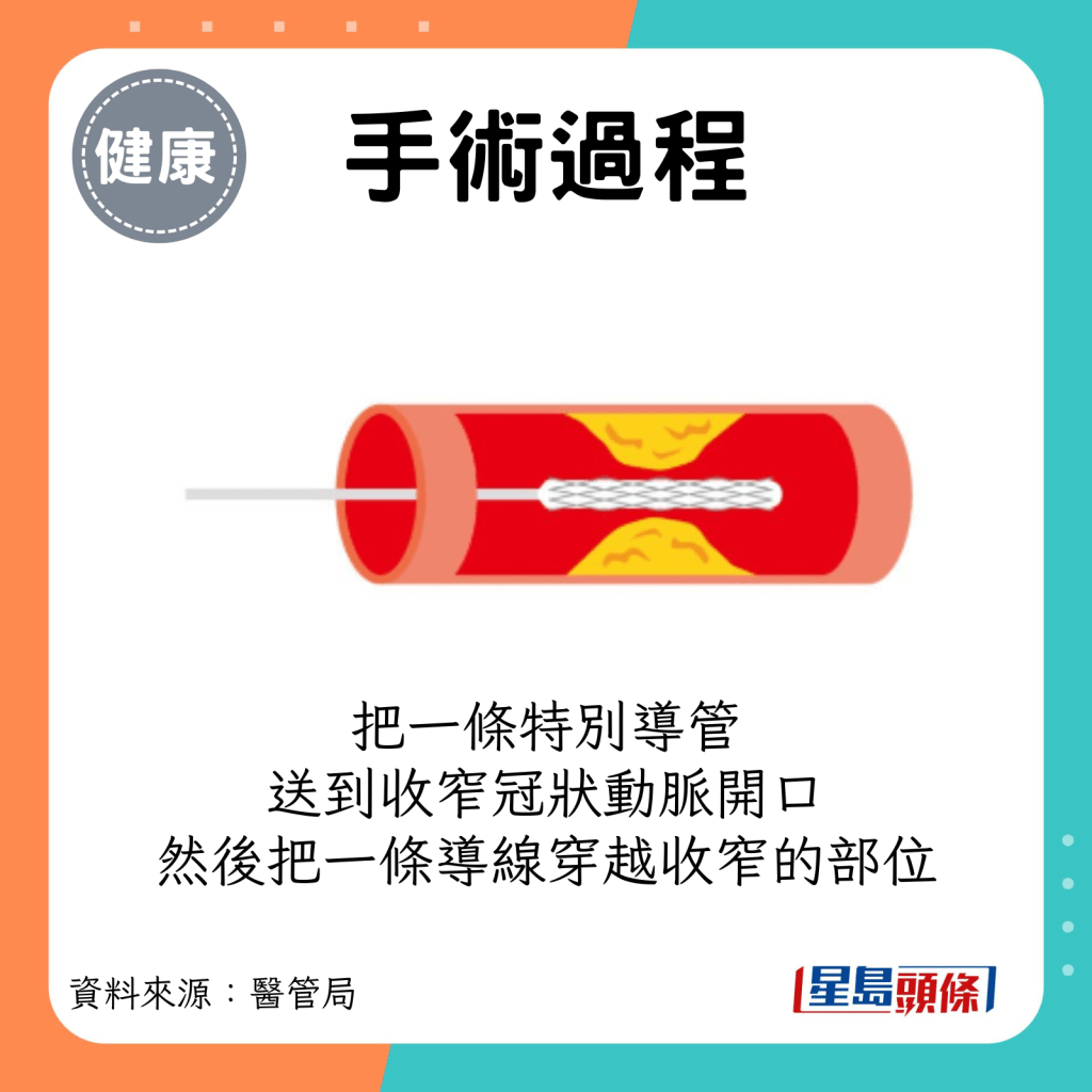 医生会把一条特别导管送到收窄的冠狀动脉的开口，然后把一条导线穿越收窄的部位。