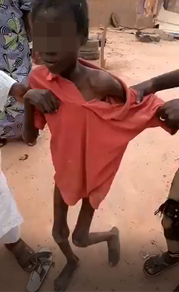 男童獲救時已骨瘦如柴。 網圖