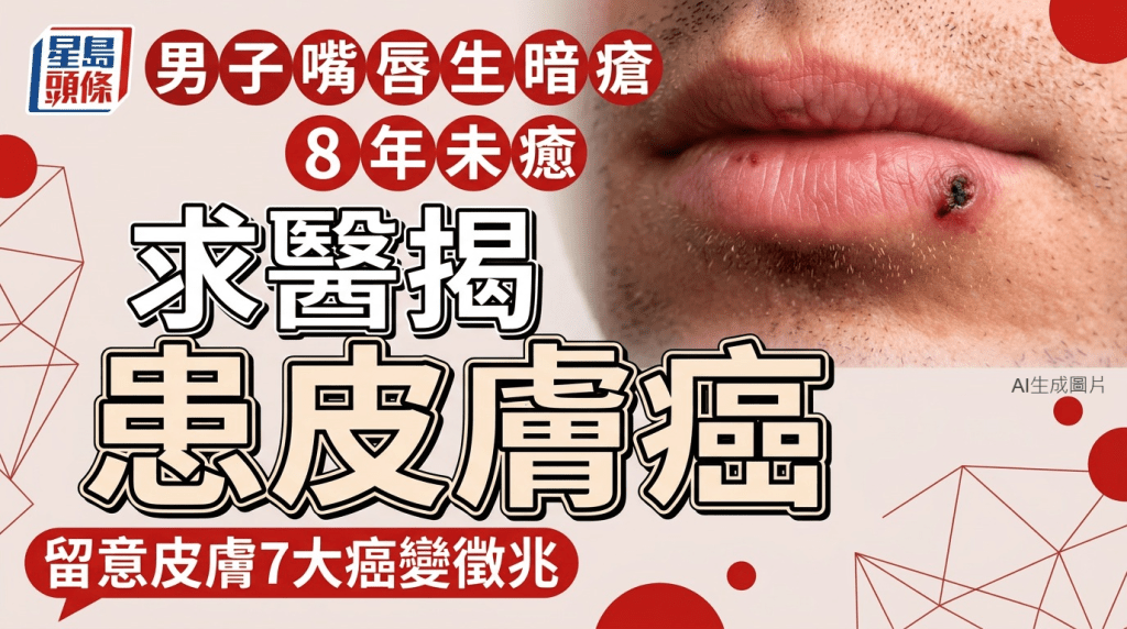 男子嘴唇生暗瘡8年未癒 求醫驚揭患皮膚癌 留意皮膚7大癌變徵兆
