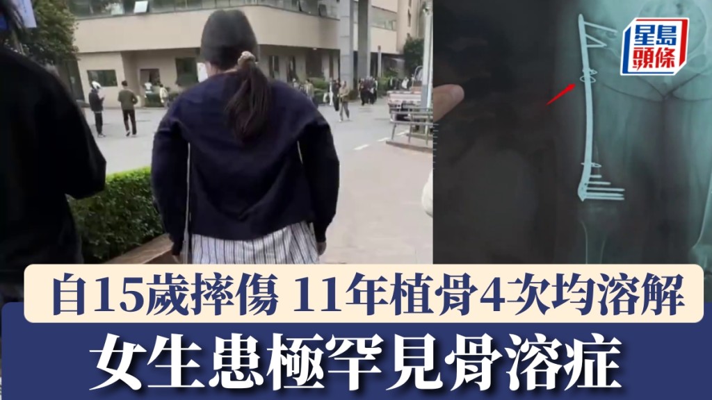 女生自15歲摔傷,11年植骨4次均溶解。