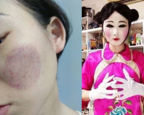 台灣女子在臉上拔罐,結果被嘲為像紙紮公仔。 (網上圖片)